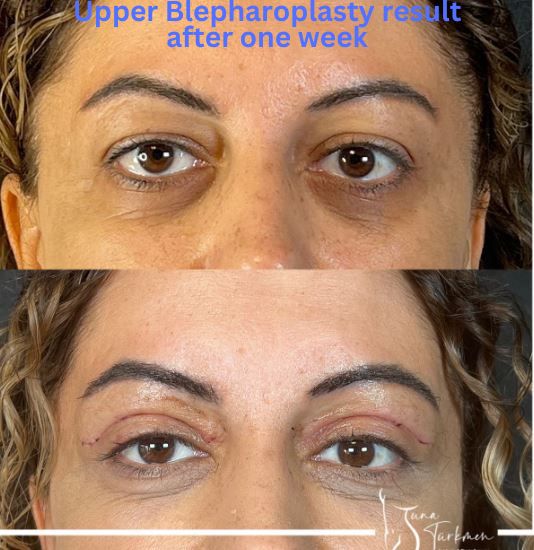 eyelid-upper-blepharoplasty-surgery